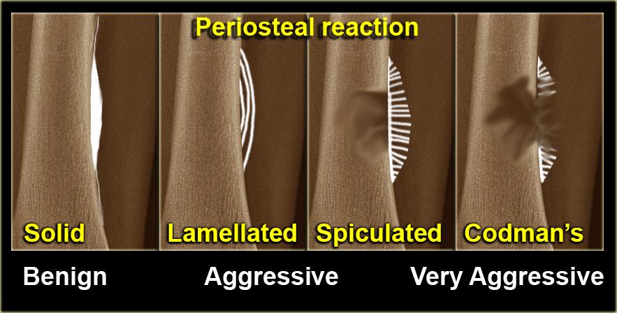 IV. Periostealis reakció/periostitis Nem specifikus jel periostealis irritatiora utal Benignus vs.