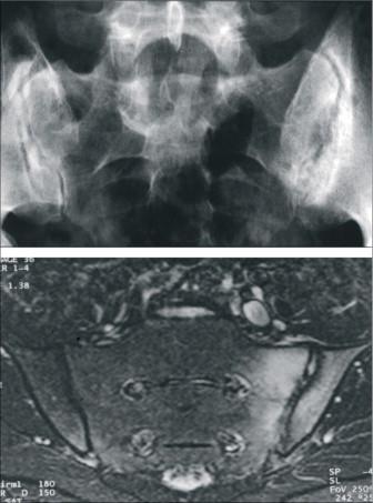 Spondylitis ankylopoetica (Bechterew kór) Synovialis és porcos ízületeket is érint (ín tapadás gyulladás-enthesitisek) Szimmetrikus
