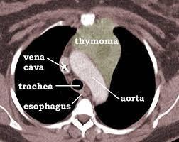 thymus carcinoma - Idősek: