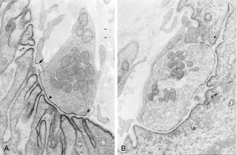 Pathophysiológia anti-achr antitest (IgG1 és 3, C fixálás): 85% - Postsynapticus membrán desorganisatio - NMJ-ban granulocyta infiltratio - A