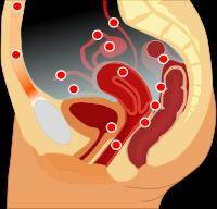 54 Dr. Med Habil Fülöp Vilmos 2. ábra Az endometriosis leggyakoribb előfordulási helyei a kismedencében és a hasfalban 1.