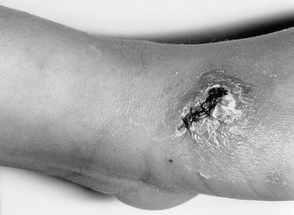 T. longibrachiatum által okozott bőrlézió Bőrlézió