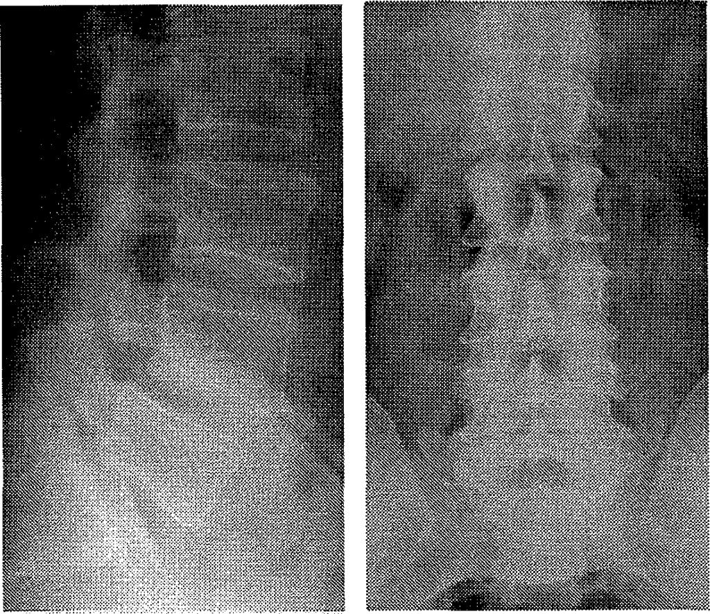 Preoperatív RTG felvétel. 37. b. ábra: F.S.