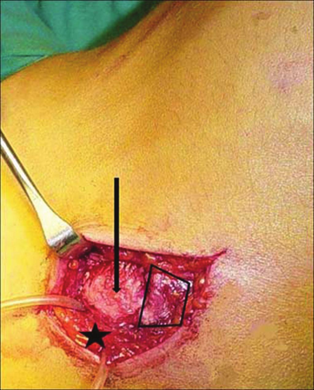Figure 1 Isolation of the ulnar nerve and partial epicondylectomy (left elbow, ulnar side - intraoperative picture).