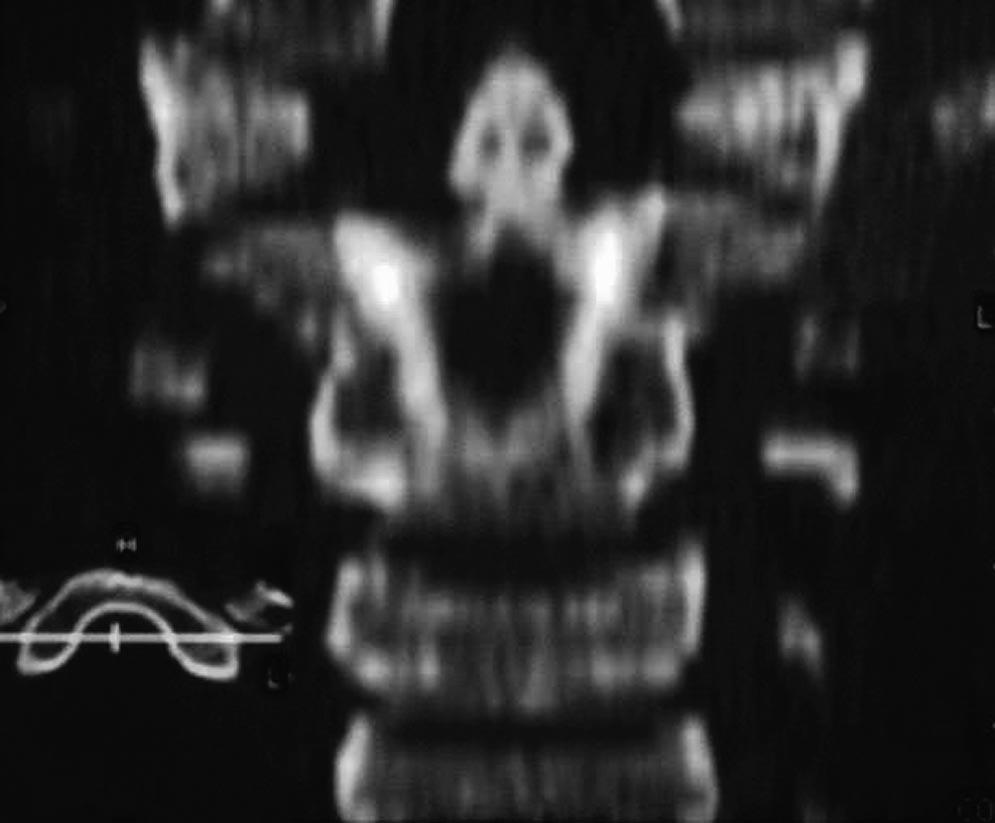 The lateral functional radiograph reveals the atlantoaxial instability. of the disease, it is classified into 3 subgroups: isolated, syndromic, and with associated anomalies.