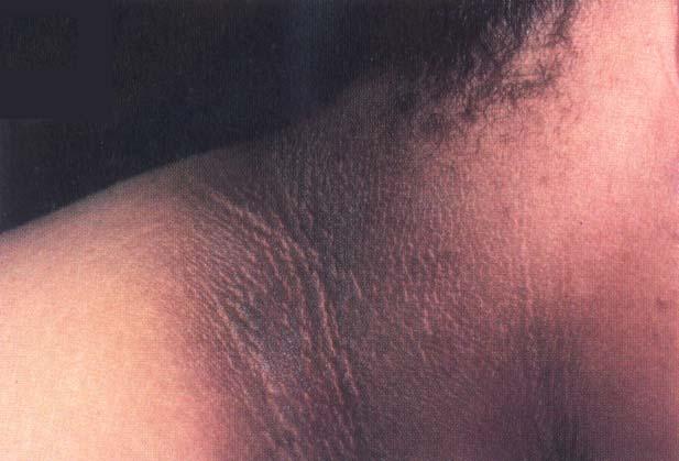 Figyelemfelkeltő jelek Családi előzmény Hypertonia Dyslipidaemia Acanthosis