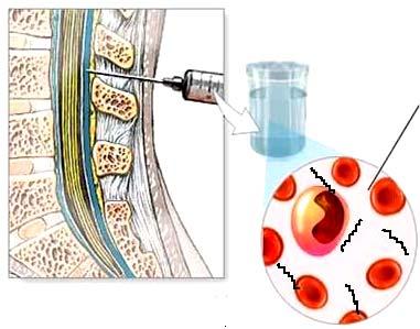 Neurolues laboratóriumi jelei Diagnosztikus likvorvizsgálatok II.