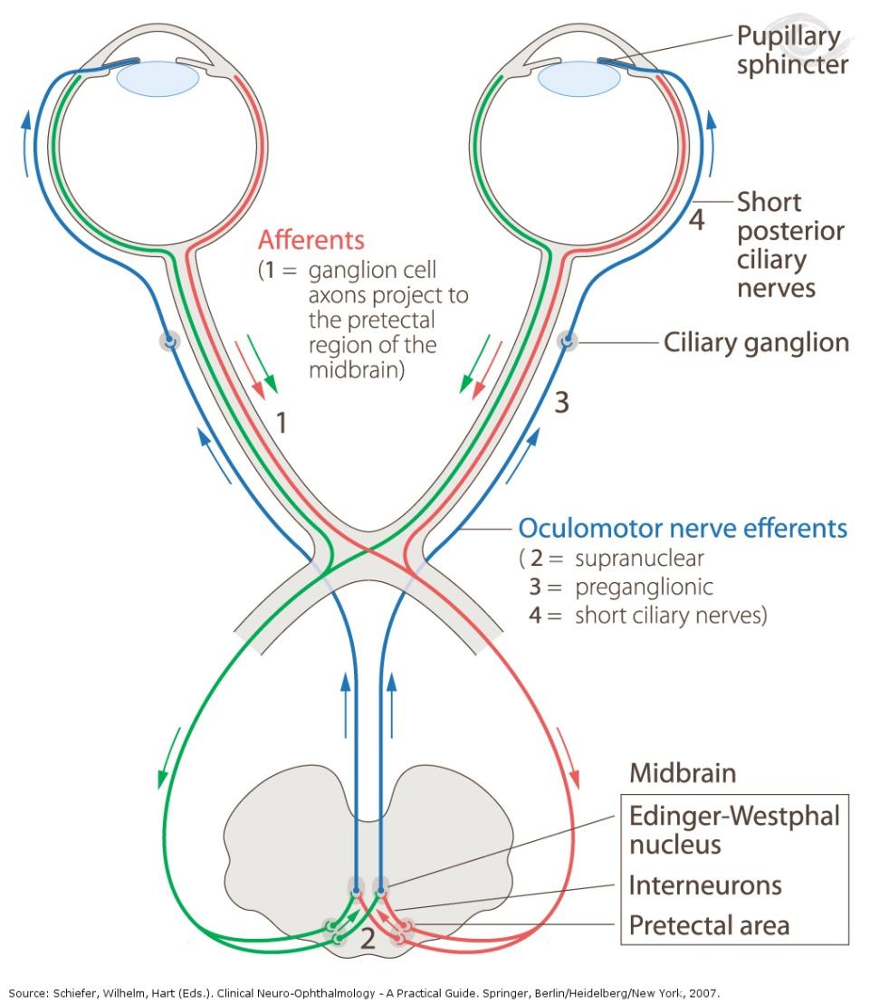 PUPILLA TÜNETEK - magassági differenciál diagnsztika - PARASYMPATICUS pályalézió Afferens szárn : amaurticus pupilla Marcus Gunn jel swinging flashlight Efferens pályán: aniscria az ún.