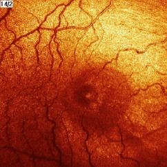 Szemtünetek LÁTÁSVESZTÉS retina+/- látóideg KETTŐSLÁTÁS szemmzgató rendszer egy