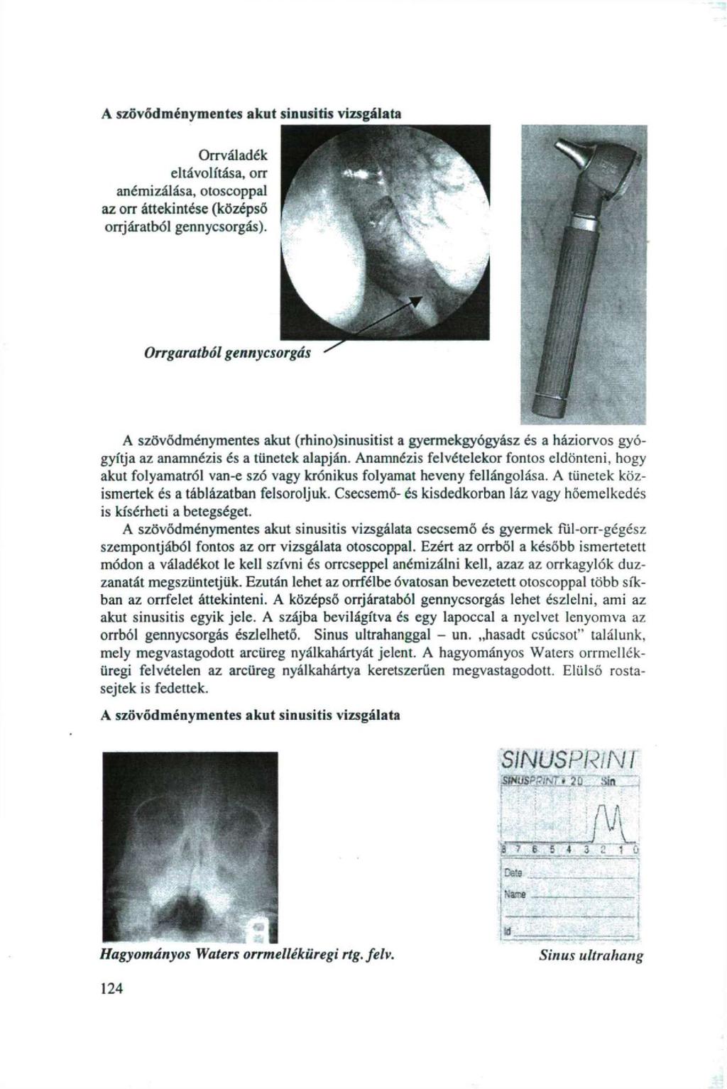 A szövődménymentes akut sinusitis vizsgálata Orrváladék eltávolítása, orr anémizálása, otoscoppal az orr áttekintése (középső orrjáratból gennycsorgás).