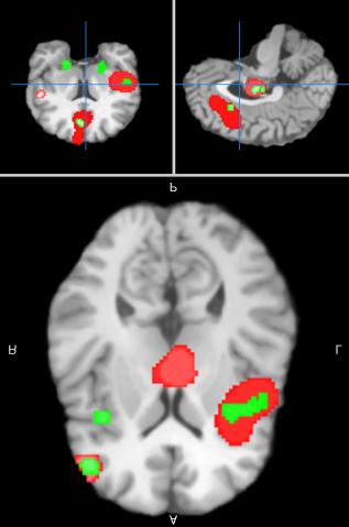 Meta analysis of functional brain imaging in specific phobia Kognitív-viselkedés terápiát követő változások az agyban (Vörös). Fóbiás inger által betegekben aktiválódott régiók (Zöld).