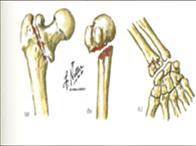 Az osteoporosis gyakorisága A lakosság 10%-ában fordul elő, mintegy 900.