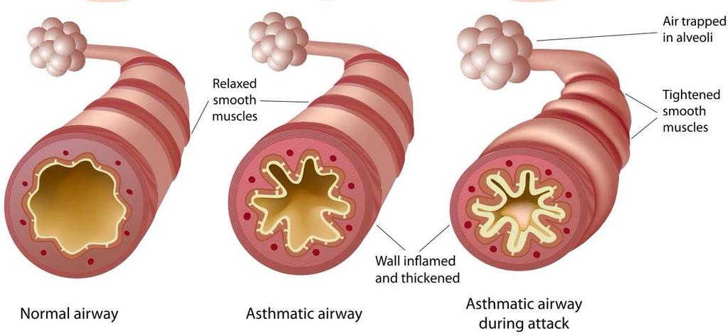 Asztmás roham Asztma: a kislégutak krónikus gyulladása Asztmás roham: kislégúti obstructio,