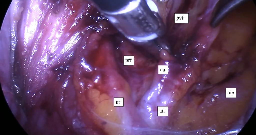1. ábra A jobb oldali arteria uterina eredésénél történő ellátása aie = arteria iliaca externa; aii = arterial iliaca interna; au = arteria uterina; prf = fossa pararectalis; pvf = fossa