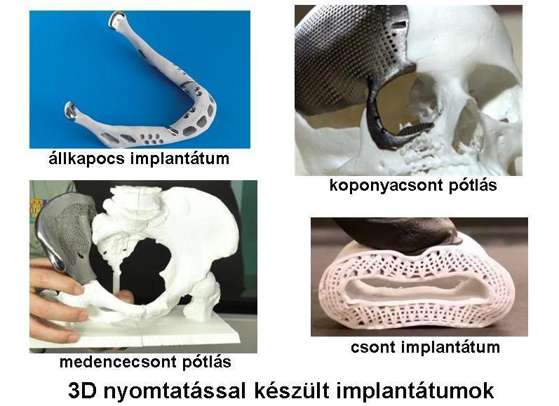 9. ábra orvosi alkalmazások- implantátumok Egyes nagy szilárdságú kompozitok azért előnyösek, mert a hagyományosan használt fémanyagokkal szemben biológiailag lebomlóak lesznek.