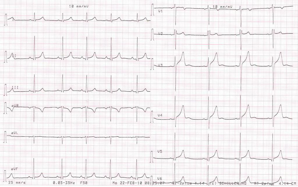 NORMÁL SPORTOLÓI EKG 23 éves férfi