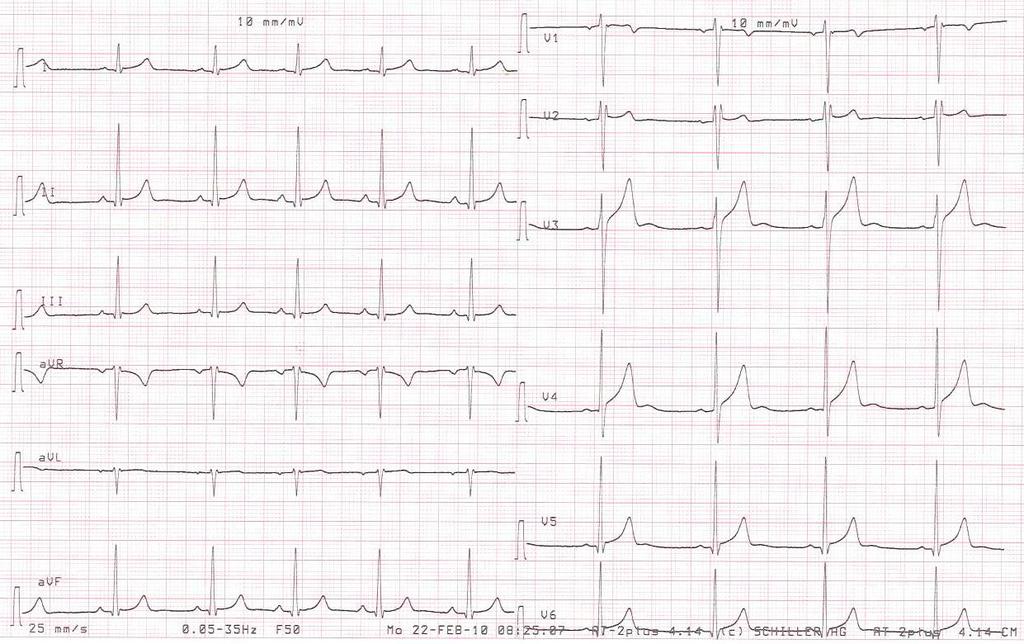 magas vérnyomás esetén 1 fokos ekg