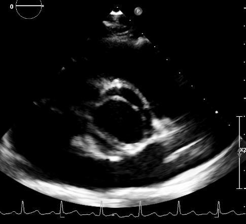 (2,3%) Nyitott foramen