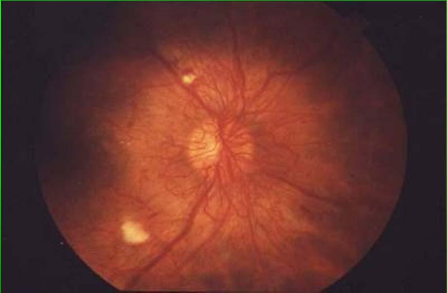 Mellékhatás: retinopathia.