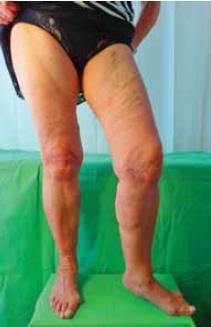 9 5. ábra. Kis fokú, recidiv varicositas az operált lábon. A betegnek panaszt nem okoz, nem kéri a felajánlott scleroterápiát.