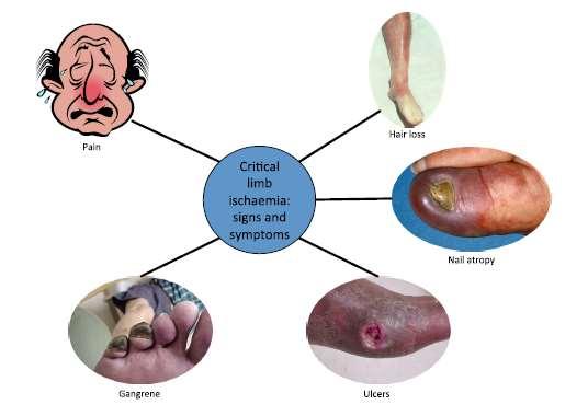 Kritikus végtag iszkémia (CLI) Tünetek és szimptómák Fájdalom Kritikus végtag iszkémia tünetei, szimptómái Sápadt bőr Atrófiás köröm Gangrena Trófikus