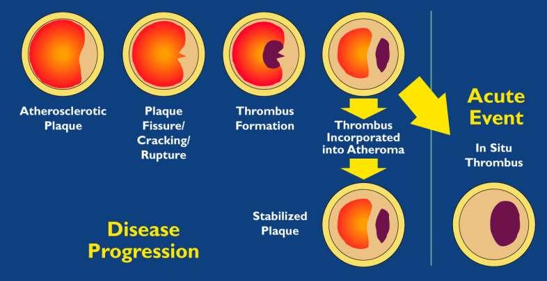 A progresszív atherosclerosis