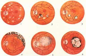 Chorioretinitis, chorioiditis Multifocalis focalis Akut inveteralt A tünetek attól függnek, hogy a maculától milyen távol van az elváltozás, ill.