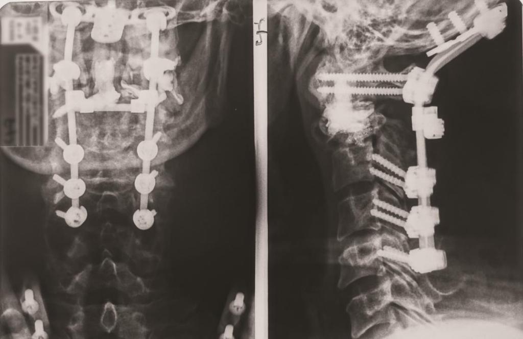 Az átlag injektált PMMA térfogat 4,0 ml volt (tartomány: 3,1-5 ml) (11. táblázat). Az injektált PMMA mennyiségét intraoperatívan mértük a fecskendőben megmaradó térfogat alapján.