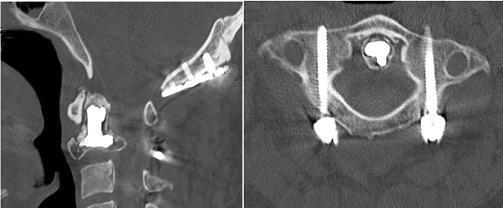 csigolyatest PMMA vertebroplasztikáját mutatja. A B A B 66. ábra.