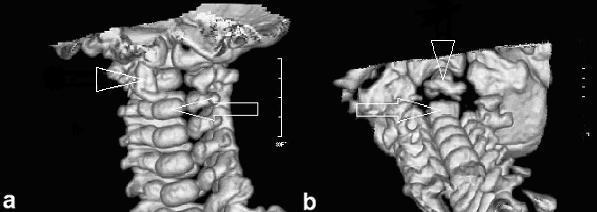 A B 78. ábra. 3D CT rekonstrukció. Hiányzó csontos struktúrák láthatóak a craniospinális régióban (nyílhegy) és sértetlen csontosodási központok a CIII alatt (nyíl). A B 79. ábra. Posztoperatív kontrasztanyag adásával készült MR felvételek.