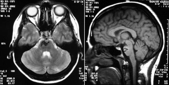 82. ábra A preoperatív axiális T2 (bal) és a sagittális T1-súlyozott (jobb) MR képek a cavernomát és a felszívódóban lévő vérzést mutatják a pons ventrális részén a jobb oldalon.