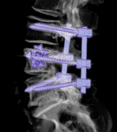 90. ábra. Utóaugmentált csavarok oldalirányú (bal) és anteroposterior (jobb) 3D CT képen.