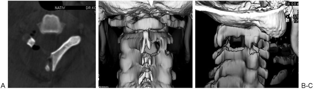 Posztoperatív axiális CT felvétel (A) és 3D rekonstrukciós képek dorzális (B) és laterális (C) nézetből mutatják a hemi-semi-laminectomiát és a részleges laterális facetectomiát, a "nyitott csatorna"