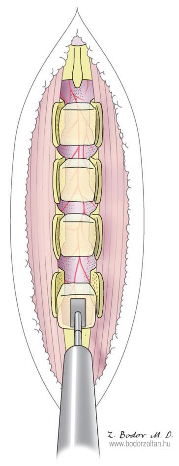 Amennyiben az intramedulláris tumor eltávolítása teljes egészében nem lehetséges (diffúz infiltratív tumor), az intraspinális tér megnagyobbítása, csontos dekompresszió válik szükségessé.