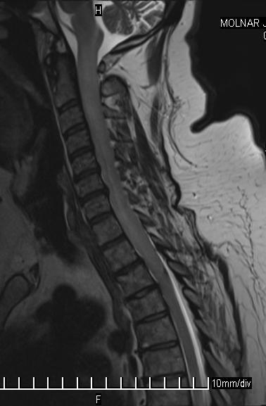 36. ábra. Preoperatív sagittális T2 súlyozású MR intramedulláris diffúz tumort mutat a CII-Th III szakaszon.