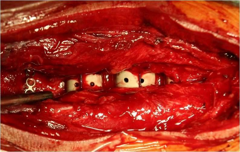 38. ábra. Az intraoperatív fénykép a szétterpesztett processus spinosusok közé helyezett PEEK távtartókat mutatja.