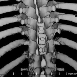 3D CT rekonstrukció a többszinten szétválasztott