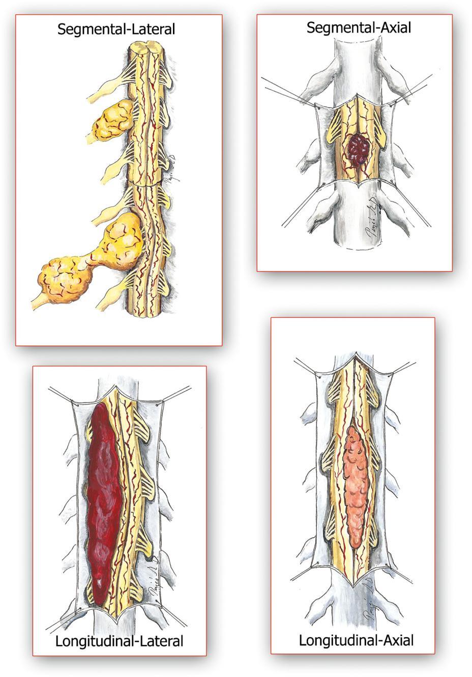 Saját megfigyeléseink és rendszerezésünk alapján elmondható, hogy a gerinccsatornában elhelyezkedő kórfolyamatok többsége vagy szegmentális-laterális (pl.