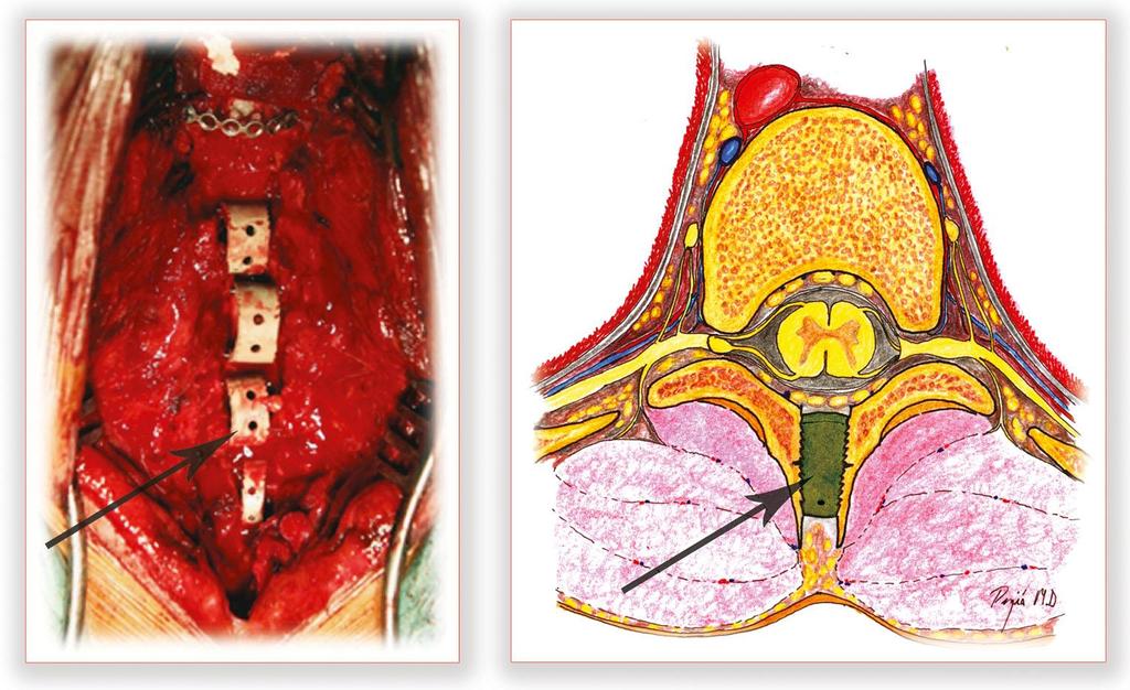 Az intraoperatív fénykép (bal) és az illusztráció (jobb) a szétterpesztett processus spinosusok közé helyezett PEEK távtartókat