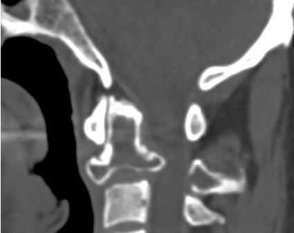 Vizsgálatunk során transzorális vagy transzpediculáris vertebroplasztikát és hátsó occipito-cervicális rögzítést végeztünk CII metasztatikus kórképek szelektált eseteiben (Papp és mtsai 20