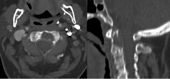 B C 59. ábra. Preoperatív axiális és szagittális CT szeletek ábrázolják az osteolytikus CII metasztatikus csigolyatest és dens elváltozásokat. Myeloma multiplex A (előző oldal), tüdő carcinoma B, C.