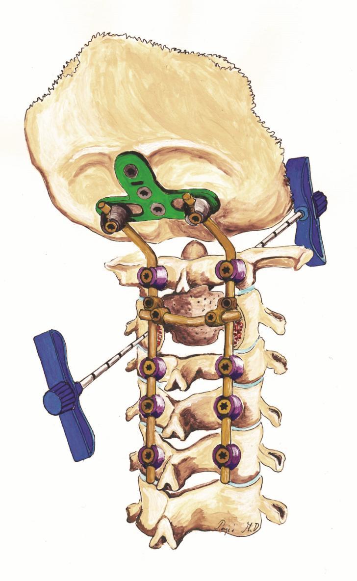 Tapasztalataink szerint a transzpediculáris PMMA (polimetil-metakrilát) injekció megfelelő metódus a CII osteolytikus metasztázisok és akár az alsóbb csigolyák kezelésében is.