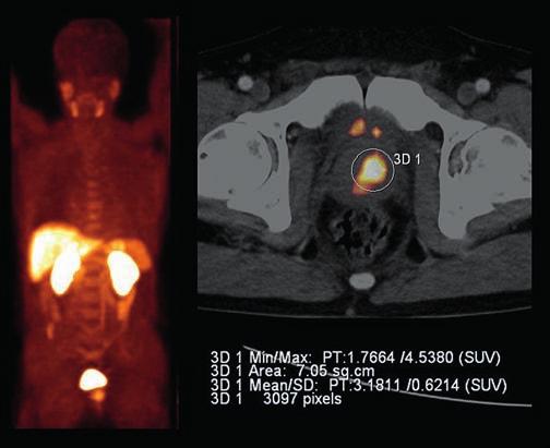 234 Borbély 3. ábra. Prosztatarák. Teljestest F-kolin MIP PET és transzverzális PET/CT metszetképek. A radiofarmakont intenzíven halmozó (SUV max. : 4,5) régiók.