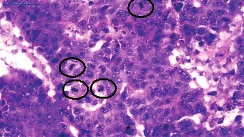 92 BORKA ben a tüdőeredetű daganatok neuroendokrin differenciációjának bizonyítására immunhisztokémiai panel elvégzését javasolják, mely során kromogranin A, szinaptofizin, NSE (neuronspecifikus