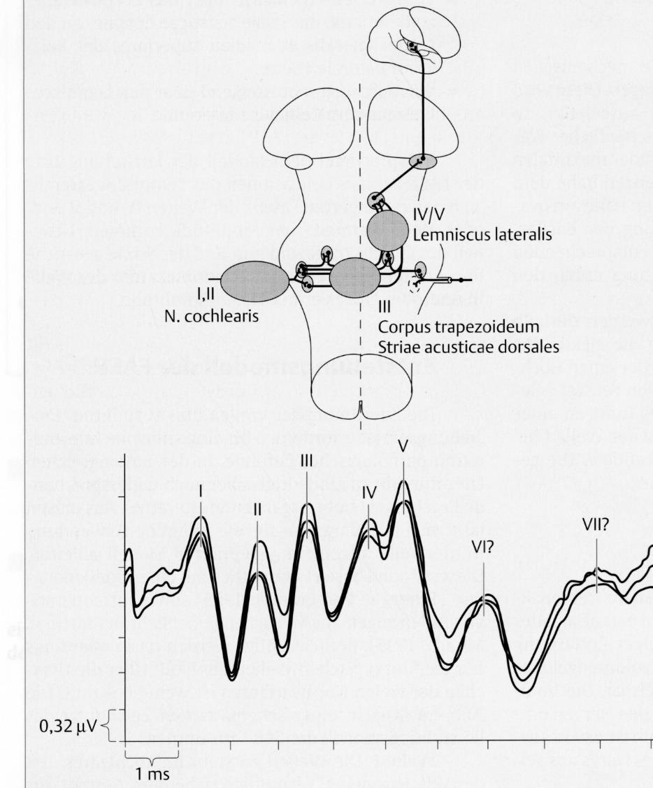 Hullám generátorok AEP Anatómiai háttér Klikkelő hangok, regisztráció a mastoid csontok felett, unilateralis ingerlés (n = 1300), bilateralis regisztráció I. N. VIII II. Nucleus cohlearis III.