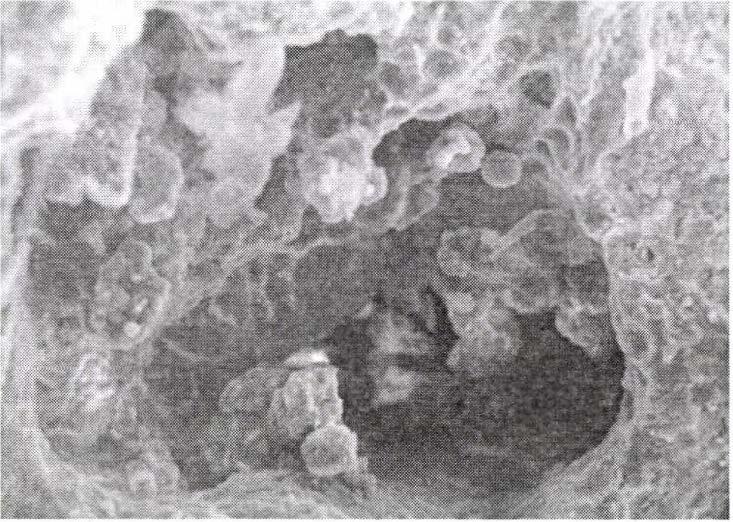 Figure 1: On the surface of the stone apatite mass, leucocytes and fibrin-fiber are visible (magnification 1410 x). 2.