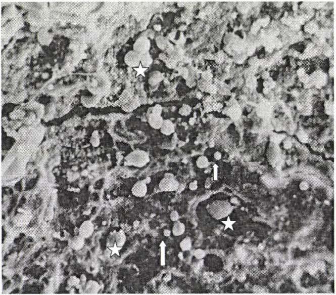 A kő metszéslapjain számos fehérvérsejt (csillag) között coccusok (nyíl) helyezkednek el (670 x nagyítás).