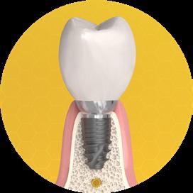 Beültetési hossz Megerősített implantátumtest Kapcsolat Extra rövid implantátumaink alkalmasak