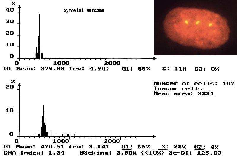 - 24 dc_59_10 3. ábra Synoviális sarcoma hisztogrammja aneuploid értékkel. Ebben az esetben transzlokációt nem találtunk, de a szintén jellegzetes 18-as triszomia FISH vizsgálattal igazolható volt.