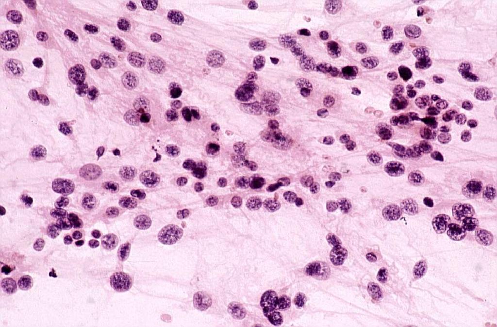 - 26-5. ábra Pleiomorh daganatsejtek myxifibrosarcomából (bal kép) és rhabdomyosarcomából (jobb kép).